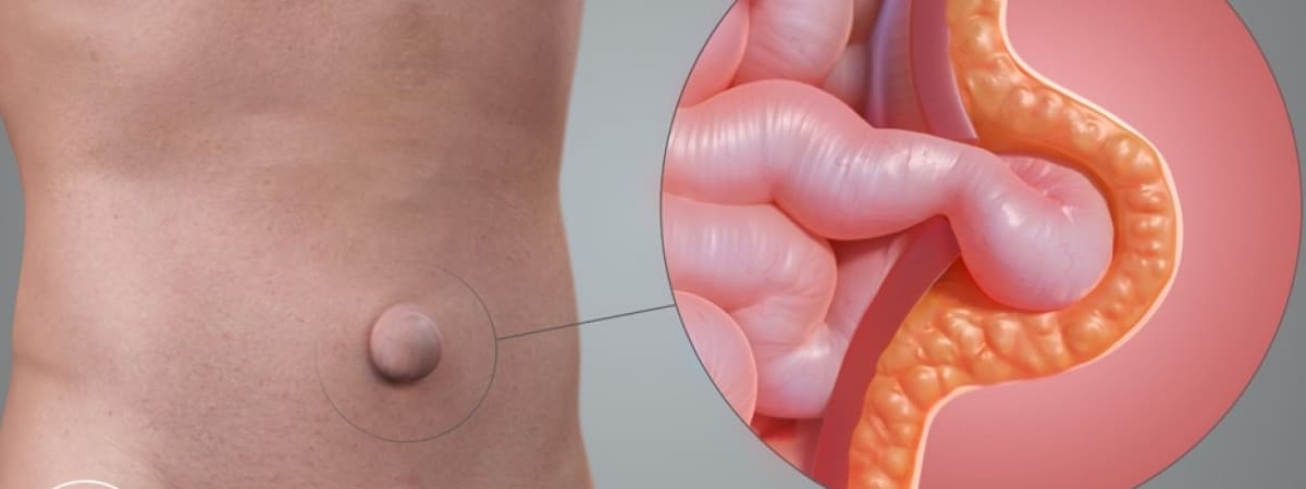 tratamiento hernia umbilical